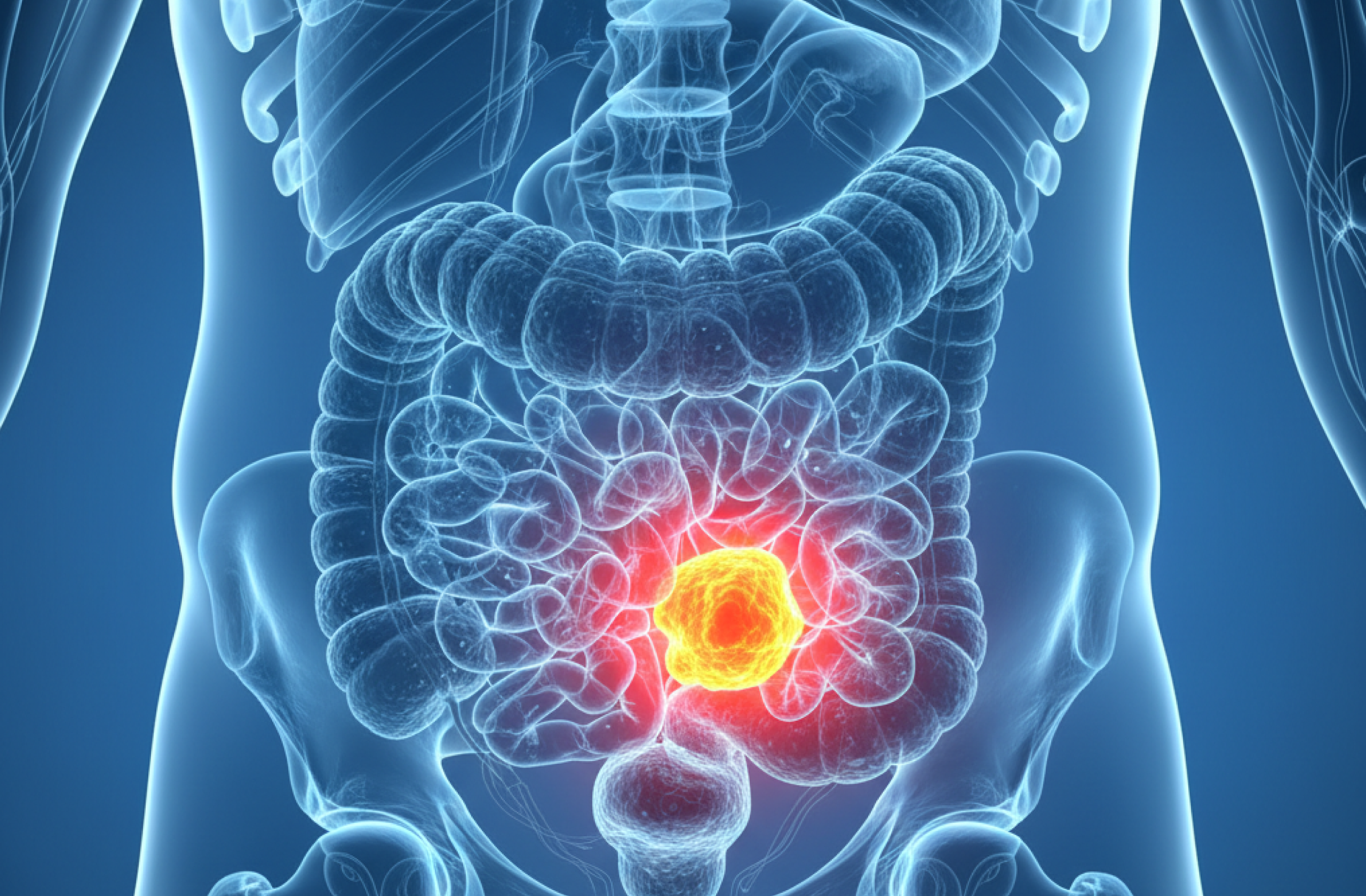 Imagen molecular PSMA PET CT en cáncer de próstata